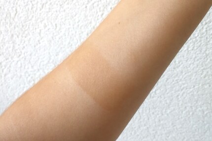 Der Allergie-Teststreifen auf meinem Unterarm nach vier Stunden Einwirkzeit