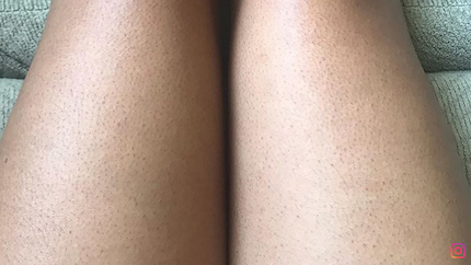 Skin covered in dark dots. Picture: Instagram @inspired_to_awe