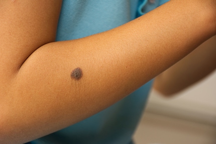 Hat dein Kind ein Muttermal am rechten Arm oder einen Leberfleck am linken Finger? Super, dann macht euch diese Eigenheit zunutze.