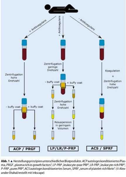 Le PRP est obtenu à partir du sang total d’une personne par une ou deux étapes de centrifugation afin d’obtenir une séparation des composants du sang.