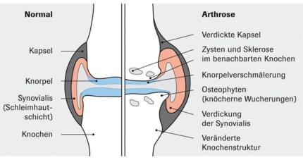 Arthrose de l’articulation du genou.