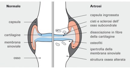 Osteoartrite del ginocchio.