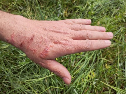 Il contatto con l'alga gigante può causare reazioni cutanee dolorose.