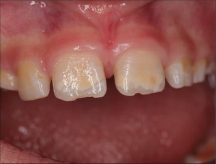 Dents incisives MMIH avec fracture de l'émail chez un enfant de six ans.