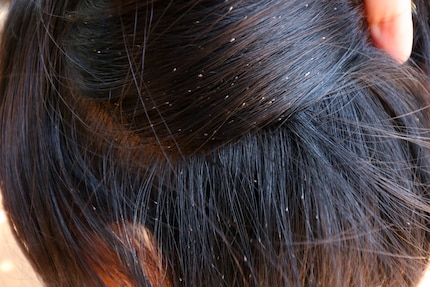 Occorre fare una pulizia generale: le uova e le lendini dei pidocchi si attaccano ai capelli.
