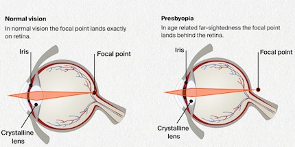 Links: Der Brennpunkt liegt auf der Netzhaut, der Mensch sieht scharf. Rechts: Die Linse kann nicht genügend zusammengedrückt werden, der Mensch ist weitsichtig.